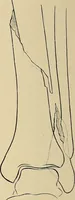 An illustration from Surgical diagnosis / by Edward Martin ... illustrated with 445 engravings and 18 plates in colors and monochrome. (1909)