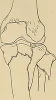Picture 126 of 129 from Surgical diagnosis / by Edward Martin ... illustrated with 445 engravings and 18 plates in colors and monochrome. (1909), leaf 640