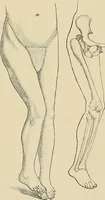 An illustration from Surgical diagnosis / by Edward Martin ... illustrated with 445 engravings and 18 plates in colors and monochrome. (1909)