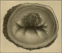 An illustration from Surgical diagnosis / by Edward Martin ... illustrated with 445 engravings and 18 plates in colors and monochrome. (1909)