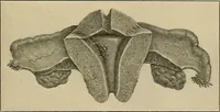 An illustration from Surgical diagnosis / by Edward Martin ... illustrated with 445 engravings and 18 plates in colors and monochrome. (1909)