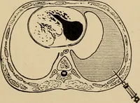 An illustration from Atlas of methods of clinical investigation : with an epitome of clinical diagnosis and of special pathology and treatment of internal diseases / By Dr. Christfried Jakob ... Authorized translation from the German. Ed. by Augustus A. Eshner ... With 182 colored illustrations upon 68 plates, and 64 illustrations in the text. (1898)
