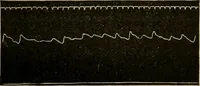 An illustration from Atlas of methods of clinical investigation : with an epitome of clinical diagnosis and of special pathology and treatment of internal diseases / By Dr. Christfried Jakob ... Authorized translation from the German. Ed. by Augustus A. Eshner ... With 182 colored illustrations upon 68 plates, and 64 illustrations in the text. (1898)