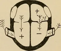 An illustration from Atlas of methods of clinical investigation : with an epitome of clinical diagnosis and of special pathology and treatment of internal diseases / By Dr. Christfried Jakob ... Authorized translation from the German. Ed. by Augustus A. Eshner ... With 182 colored illustrations upon 68 plates, and 64 illustrations in the text. (1898)