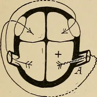 An illustration from Atlas of methods of clinical investigation : with an epitome of clinical diagnosis and of special pathology and treatment of internal diseases / By Dr. Christfried Jakob ... Authorized translation from the German. Ed. by Augustus A. Eshner ... With 182 colored illustrations upon 68 plates, and 64 illustrations in the text. (1898)
