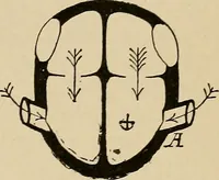 An illustration from Atlas of methods of clinical investigation : with an epitome of clinical diagnosis and of special pathology and treatment of internal diseases / By Dr. Christfried Jakob ... Authorized translation from the German. Ed. by Augustus A. Eshner ... With 182 colored illustrations upon 68 plates, and 64 illustrations in the text. (1898)