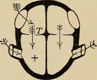 An illustration from Atlas of methods of clinical investigation : with an epitome of clinical diagnosis and of special pathology and treatment of internal diseases / By Dr. Christfried Jakob ... Authorized translation from the German. Ed. by Augustus A. Eshner ... With 182 colored illustrations upon 68 plates, and 64 illustrations in the text. (1898)