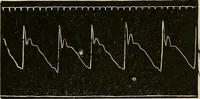 An illustration from Atlas of methods of clinical investigation : with an epitome of clinical diagnosis and of special pathology and treatment of internal diseases / By Dr. Christfried Jakob ... Authorized translation from the German. Ed. by Augustus A. Eshner ... With 182 colored illustrations upon 68 plates, and 64 illustrations in the text. (1898)