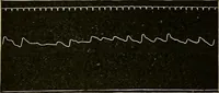 An illustration from Atlas of methods of clinical investigation : with an epitome of clinical diagnosis and of special pathology and treatment of internal diseases / By Dr. Christfried Jakob ... Authorized translation from the German. Ed. by Augustus A. Eshner ... With 182 colored illustrations upon 68 plates, and 64 illustrations in the text. (1898)