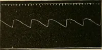 An illustration from Atlas of methods of clinical investigation : with an epitome of clinical diagnosis and of special pathology and treatment of internal diseases / By Dr. Christfried Jakob ... Authorized translation from the German. Ed. by Augustus A. Eshner ... With 182 colored illustrations upon 68 plates, and 64 illustrations in the text. (1898)