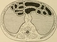 An illustration from Atlas of methods of clinical investigation : with an epitome of clinical diagnosis and of special pathology and treatment of internal diseases / By Dr. Christfried Jakob ... Authorized translation from the German. Ed. by Augustus A. Eshner ... With 182 colored illustrations upon 68 plates, and 64 illustrations in the text. (1898)