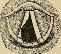 An illustration from Atlas of methods of clinical investigation : with an epitome of clinical diagnosis and of special pathology and treatment of internal diseases / By Dr. Christfried Jakob ... Authorized translation from the German. Ed. by Augustus A. Eshner ... With 182 colored illustrations upon 68 plates, and 64 illustrations in the text. (1898)