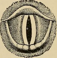 An illustration from Atlas of methods of clinical investigation : with an epitome of clinical diagnosis and of special pathology and treatment of internal diseases / By Dr. Christfried Jakob ... Authorized translation from the German. Ed. by Augustus A. Eshner ... With 182 colored illustrations upon 68 plates, and 64 illustrations in the text. (1898)