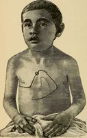 An illustration from Atlas of methods of clinical investigation : with an epitome of clinical diagnosis and of special pathology and treatment of internal diseases / By Dr. Christfried Jakob ... Authorized translation from the German. Ed. by Augustus A. Eshner ... With 182 colored illustrations upon 68 plates, and 64 illustrations in the text. (1898)