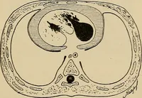 An illustration from Atlas of methods of clinical investigation : with an epitome of clinical diagnosis and of special pathology and treatment of internal diseases / By Dr. Christfried Jakob ... Authorized translation from the German. Ed. by Augustus A. Eshner ... With 182 colored illustrations upon 68 plates, and 64 illustrations in the text. (1898)