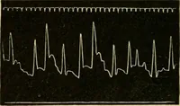 An illustration from Atlas of methods of clinical investigation : with an epitome of clinical diagnosis and of special pathology and treatment of internal diseases / By Dr. Christfried Jakob ... Authorized translation from the German. Ed. by Augustus A. Eshner ... With 182 colored illustrations upon 68 plates, and 64 illustrations in the text. (1898)