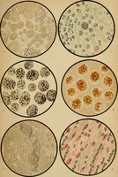 An illustration from Atlas of methods of clinical investigation : with an epitome of clinical diagnosis and of special pathology and treatment of internal diseases / By Dr. Christfried Jakob ... Authorized translation from the German. Ed. by Augustus A. Eshner ... With 182 colored illustrations upon 68 plates, and 64 illustrations in the text. (1898)