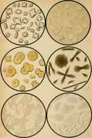 An illustration from Atlas of methods of clinical investigation : with an epitome of clinical diagnosis and of special pathology and treatment of internal diseases / By Dr. Christfried Jakob ... Authorized translation from the German. Ed. by Augustus A. Eshner ... With 182 colored illustrations upon 68 plates, and 64 illustrations in the text. (1898)