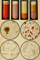 An illustration from Atlas of methods of clinical investigation : with an epitome of clinical diagnosis and of special pathology and treatment of internal diseases / By Dr. Christfried Jakob ... Authorized translation from the German. Ed. by Augustus A. Eshner ... With 182 colored illustrations upon 68 plates, and 64 illustrations in the text. (1898)