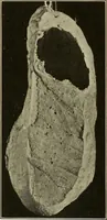 An illustration from The diseases of infancy and childhood : for the use of students and practitioners of medicine / by L. Emmett Holt and John Howland. (1911)
