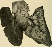 An illustration from The diseases of infancy and childhood : for the use of students and practitioners of medicine / by L. Emmett Holt and John Howland. (1911)