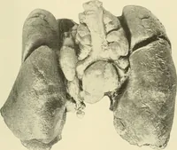 An illustration from The diseases of infancy and childhood : for the use of students and practitioners of medicine / by L. Emmett Holt and John Howland. (1911)