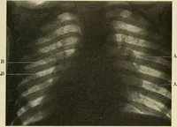 An illustration from The diseases of infancy and childhood : for the use of students and practitioners of medicine / by L. Emmett Holt and John Howland. (1911)
