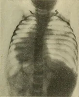 An illustration from The diseases of infancy and childhood : for the use of students and practitioners of medicine / by L. Emmett Holt and John Howland. (1911)