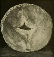 An illustration from The diseases of infancy and childhood : for the use of students and practitioners of medicine / by L. Emmett Holt and John Howland. (1911)