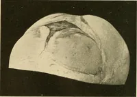 An illustration from The diseases of infancy and childhood : for the use of students and practitioners of medicine / by L. Emmett Holt and John Howland. (1911)