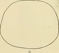 An illustration from The diseases of infancy and childhood : for the use of students and practitioners of medicine / by L. Emmett Holt and John Howland. (1911)