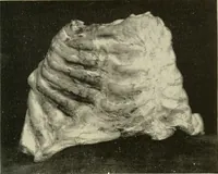 An illustration from The diseases of infancy and childhood : for the use of students and practitioners of medicine / by L. Emmett Holt and John Howland. (1911)
