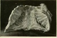 An illustration from The diseases of infancy and childhood : for the use of students and practitioners of medicine / by L. Emmett Holt and John Howland. (1911)