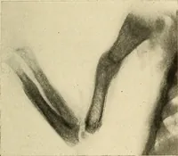 An illustration from The diseases of infancy and childhood : for the use of students and practitioners of medicine / by L. Emmett Holt and John Howland. (1911)