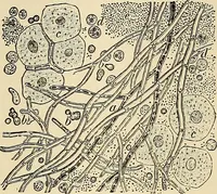 Picture 38 of 129 from The diseases of infancy and childhood : for the use of students and practitioners of medicine / by L. Emmett Holt and John Howland. (1911), leaf 312