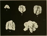 An illustration from The diseases of infancy and childhood : for the use of students and practitioners of medicine / by L. Emmett Holt and John Howland. (1911)