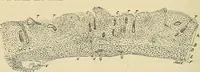 An illustration from The diseases of infancy and childhood : for the use of students and practitioners of medicine / by L. Emmett Holt and John Howland. (1911)