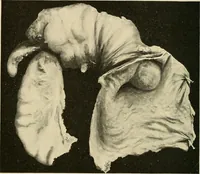 Picture 52 of 129 from The diseases of infancy and childhood : for the use of students and practitioners of medicine / by L. Emmett Holt and John Howland. (1911), leaf 452