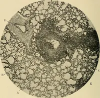 An illustration from The diseases of infancy and childhood : for the use of students and practitioners of medicine / by L. Emmett Holt and John Howland. (1911)