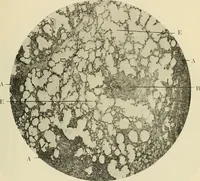 An illustration from The diseases of infancy and childhood : for the use of students and practitioners of medicine / by L. Emmett Holt and John Howland. (1911)