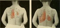 Picture 62 of 129 from The diseases of infancy and childhood : for the use of students and practitioners of medicine / by L. Emmett Holt and John Howland. (1911), leaf 554