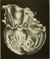 An illustration from The diseases of infancy and childhood : for the use of students and practitioners of medicine / by L. Emmett Holt and John Howland. (1911)