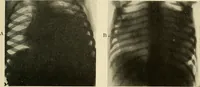 An illustration from The diseases of infancy and childhood : for the use of students and practitioners of medicine / by L. Emmett Holt and John Howland. (1911)