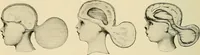 An illustration from The diseases of infancy and childhood : for the use of students and practitioners of medicine / by L. Emmett Holt and John Howland. (1911)