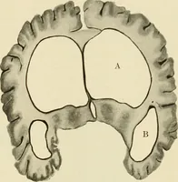 An illustration from The diseases of infancy and childhood : for the use of students and practitioners of medicine / by L. Emmett Holt and John Howland. (1911)