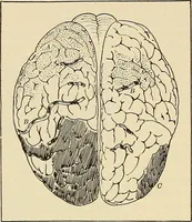 An illustration from The diseases of infancy and childhood : for the use of students and practitioners of medicine / by L. Emmett Holt and John Howland. (1911)
