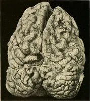 An illustration from The diseases of infancy and childhood : for the use of students and practitioners of medicine / by L. Emmett Holt and John Howland. (1911)