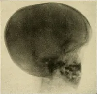 Picture 88 of 129 from The diseases of infancy and childhood : for the use of students and practitioners of medicine / by L. Emmett Holt and John Howland. (1911), leaf 814