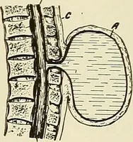 An illustration from The diseases of infancy and childhood : for the use of students and practitioners of medicine / by L. Emmett Holt and John Howland. (1911)
