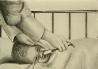 An illustration from The diseases of infancy and childhood : for the use of students and practitioners of medicine / by L. Emmett Holt and John Howland. (1911)